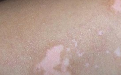 女性私密部位痒起皮屑,揭秘女性私密部位健康之谜