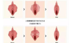 做私密整形的多少人有钱,揭秘有多少人愿意为美丽买单