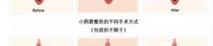 做私密整形的多少人有钱,揭秘有多少人愿意为美丽买单